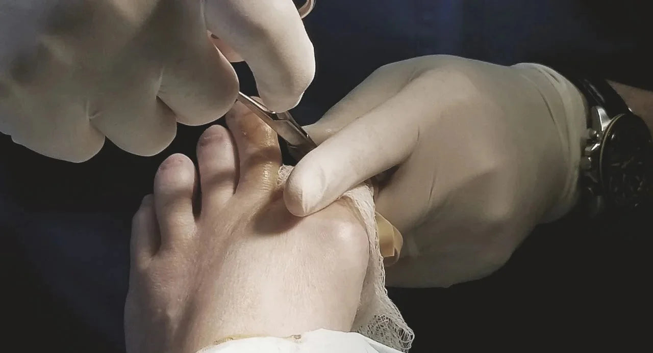 Bonex Bunion Fix 17 Bonex Bunion Fix