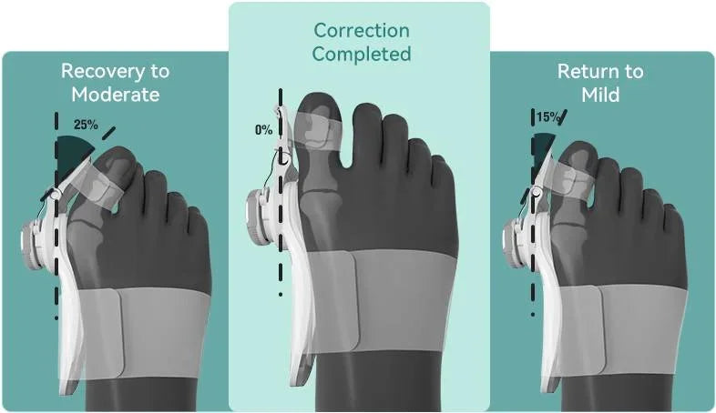 Bonex Bunion Fix 19 Bonex Bunion Fix