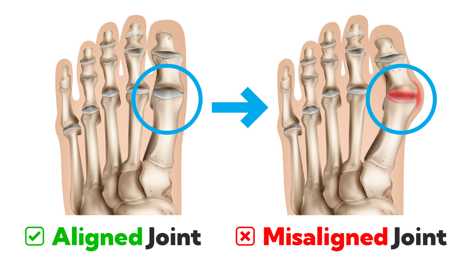 Bonex Bunion Fix 16 Bonex Bunion Fix