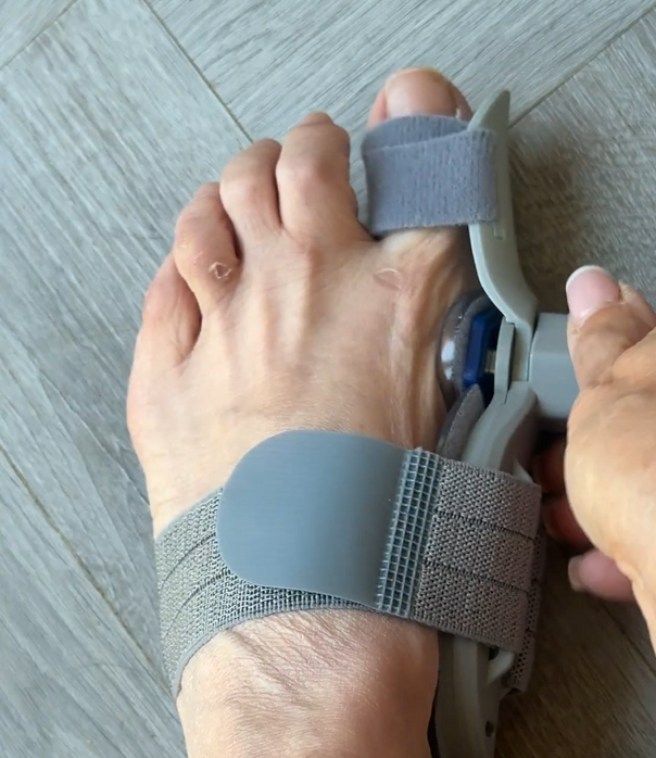 Bonex Bunion Fix 27 Bonex Bunion Fix